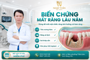 Banner giới thiệu các biến chứng mất răng lâu năm như tiêu xương hàm, răng xô lệch, sai khớp cắn và khó phục hồi Implant tại Nha khoa Ngọc Tuấn.