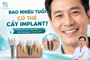 Bao nhiêu tuổi có thể cấy Implant phụ thuộc vào sự phát triển xương hàm, sức khỏe toàn thân và tình trạng răng miệng của từng người.