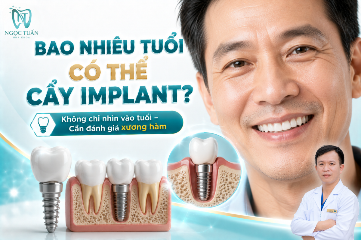 Bao nhiêu tuổi có thể cấy Implant phụ thuộc vào sự phát triển xương hàm, sức khỏe toàn thân và tình trạng răng miệng của từng người.