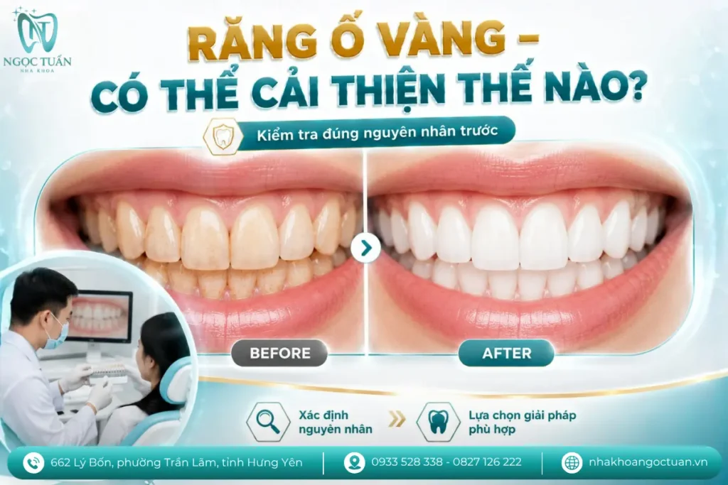 Răng ố vàng do cà phê có thể được cải thiện bằng vệ sinh, đánh bóng hoặc tẩy trắng tùy nguyên nhân và tình trạng răng.