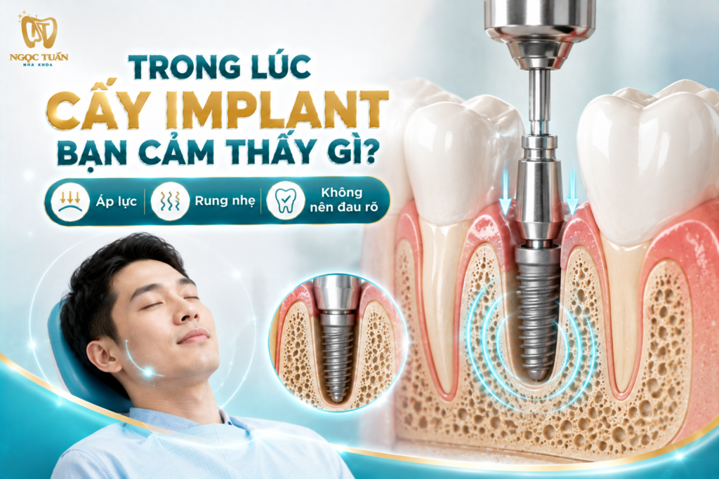 Khi vùng điều trị được gây tê đầy đủ, người cấy Implant có thể cảm nhận áp lực và rung nhưng không nên xuất hiện đau rõ.