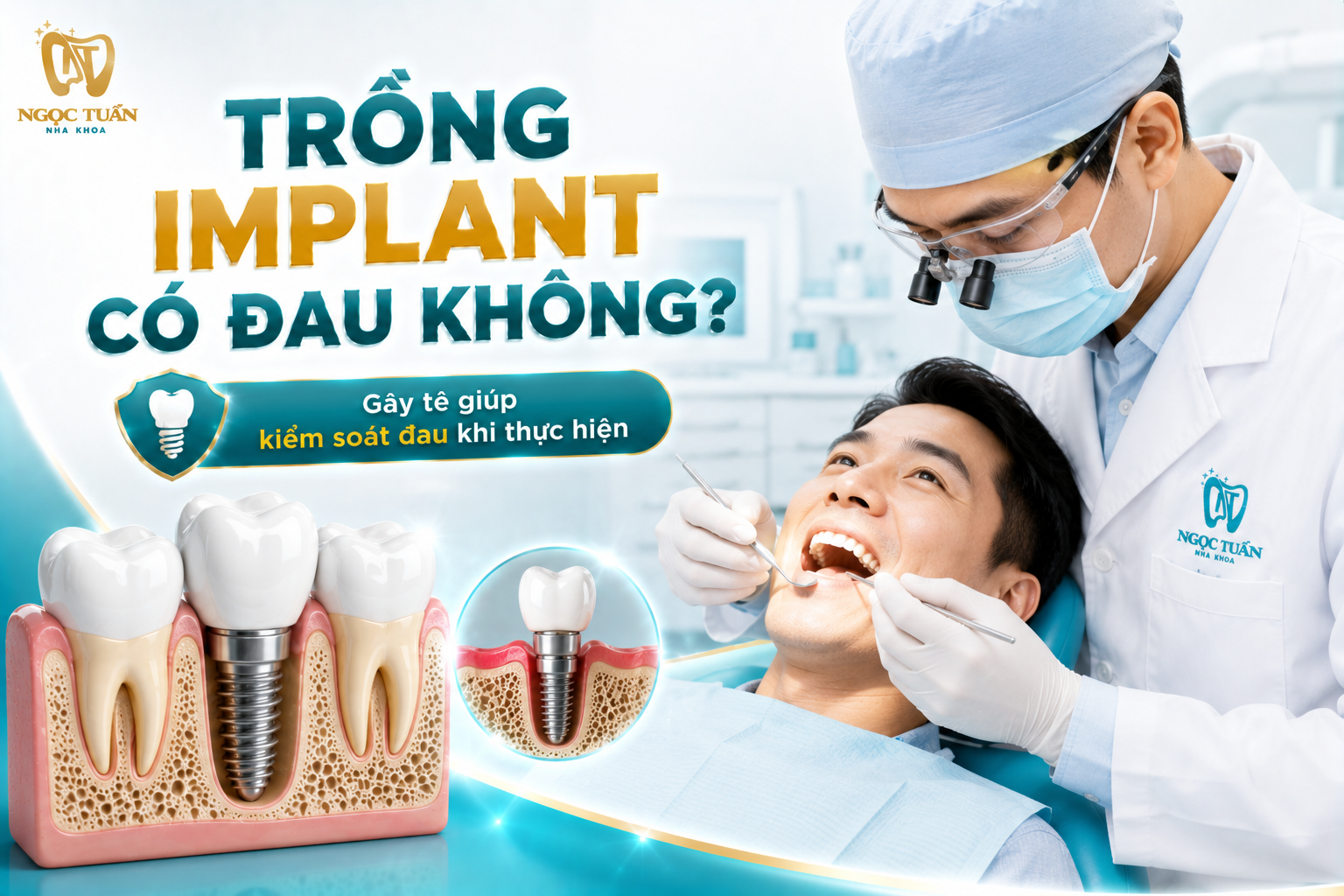 Trồng Implant thường được thực hiện với gây tê tại chỗ nhằm kiểm soát cảm giác đau trong quá trình đặt trụ.