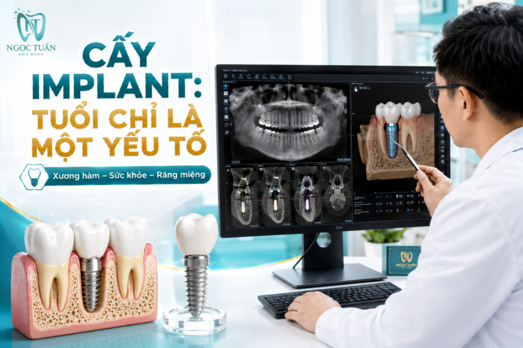 Trước khi cấy Implant, bác sĩ cần đánh giá xương hàm, sức khỏe toàn thân và tình trạng răng miệng thay vì chỉ dựa vào tuổi.