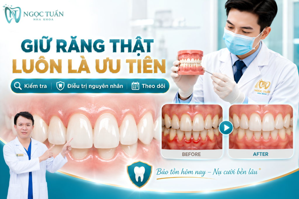Khi răng còn khả năng điều trị, xác định nguyên nhân và kiểm soát bệnh sớm có ý nghĩa quan trọng đối với việc bảo tồn răng thật.