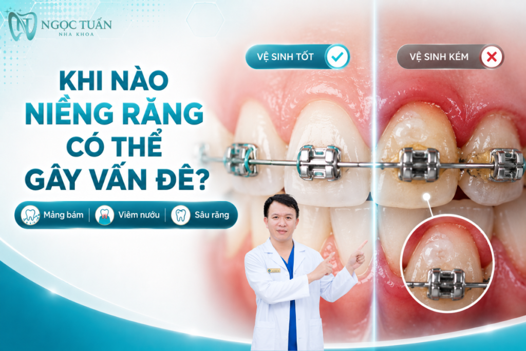 Vệ sinh không tốt khi niềng có thể làm mảng bám tích tụ quanh mắc cài, tăng nguy cơ viêm nướu, mất khoáng men và sâu răng.