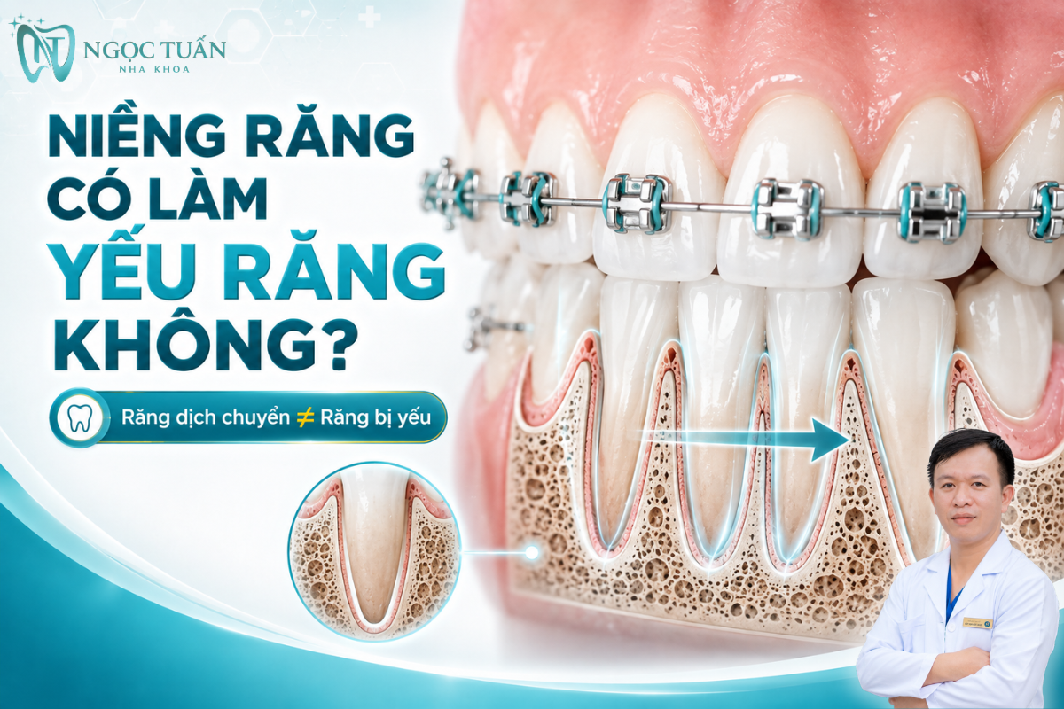 Niềng răng đúng chỉ định không đồng nghĩa làm răng yếu, răng dịch chuyển nhờ quá trình tái cấu trúc mô quanh chân răng.