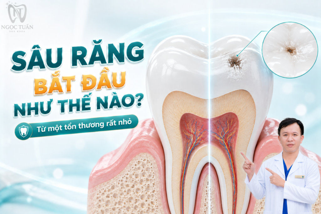Sâu răng bắt đầu từ quá trình mất khoáng men do axit được tạo ra bởi vi khuẩn trong mảng bám khi có carbohydrate dễ lên men.