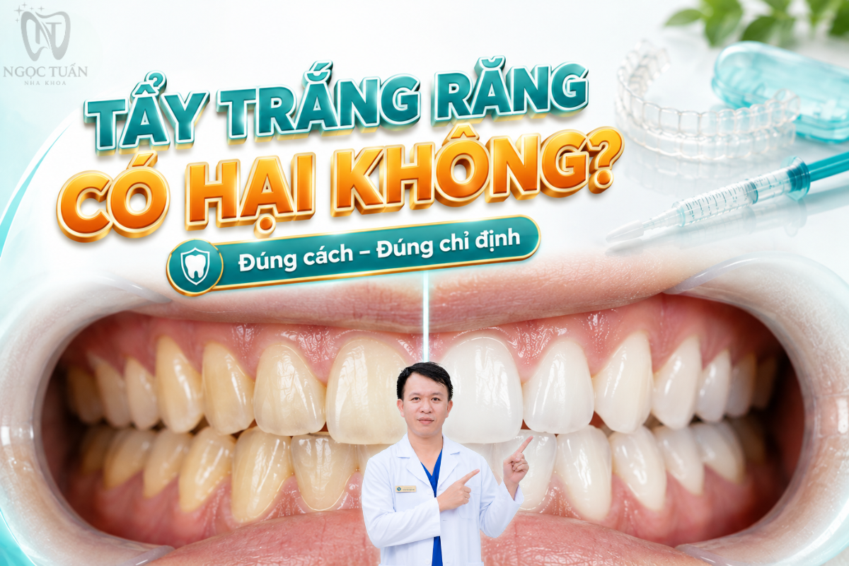 Tẩy trắng răng có hại không? Khi thực hiện đúng chỉ định và sử dụng sản phẩm phù hợp, tẩy trắng không đồng nghĩa với việc làm yếu răng.