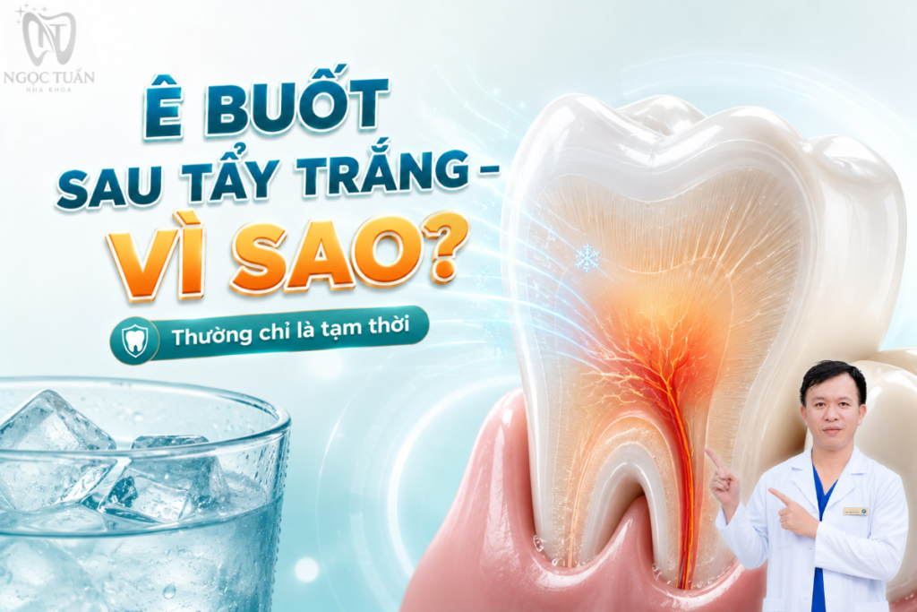 Ê buốt là tác dụng phụ có thể xuất hiện trong hoặc sau khi tẩy trắng và thường mang tính tạm thời ở nhiều trường hợp.