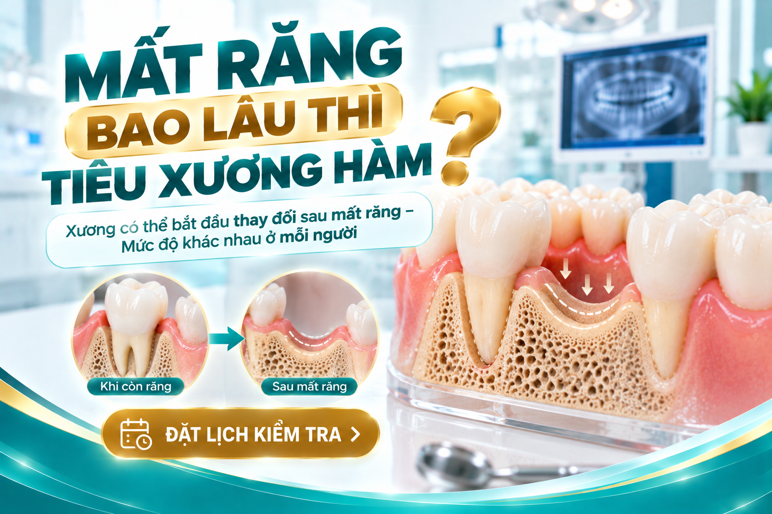 Giải thích thời điểm xương hàm bắt đầu thay đổi sau khi mất răng và lý do mức độ tiêu xương khác nhau ở mỗi người.