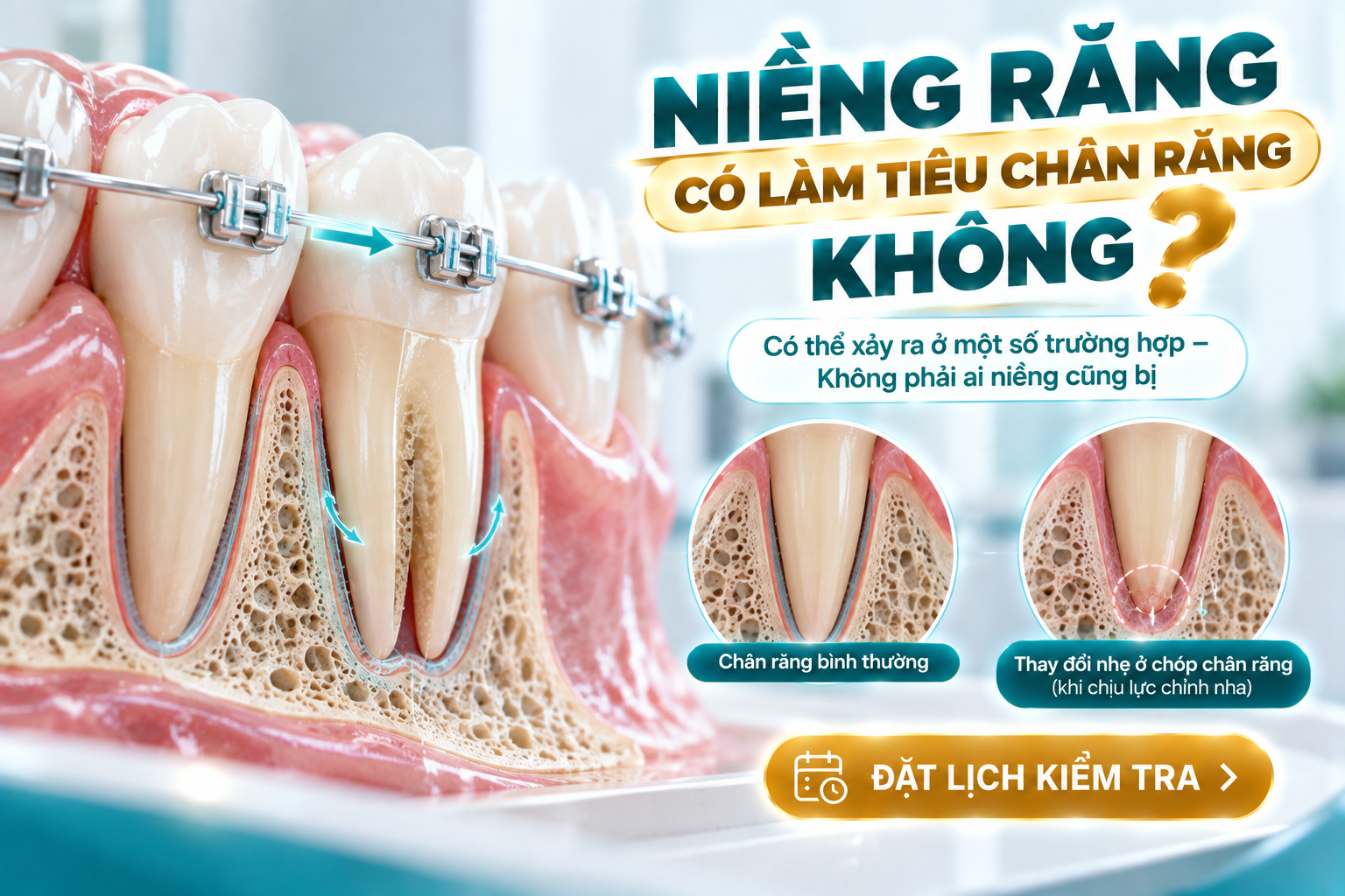 Giải thích nguy cơ tiêu chân răng trong quá trình chỉnh nha và lý do không phải người niềng nào cũng gặp tình trạng đáng kể.