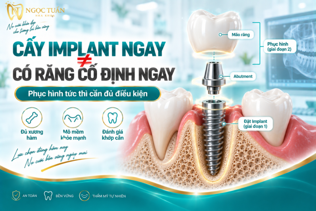 Cấy Implant ngay sau nhổ răng không đồng nghĩa bệnh nhân luôn có thể lắp răng cố định và chịu lực ngay.