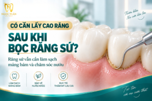 Minh họa việc kiểm tra và lấy cao răng sau khi bọc răng sứ nhằm duy trì sức khỏe nướu và phục hình.