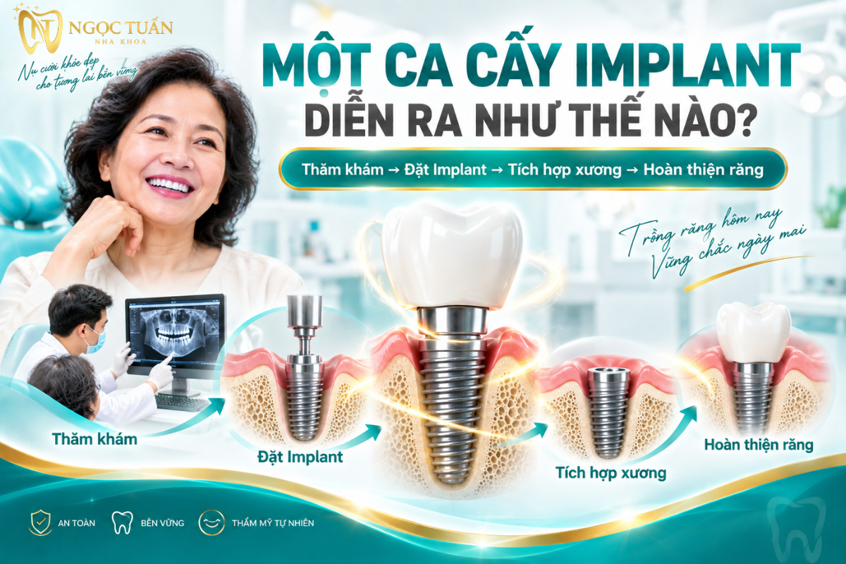 Một ca cấy Implant thường trải qua thăm khám, đánh giá xương, đặt trụ, theo dõi tích hợp xương và hoàn thiện phục hình.