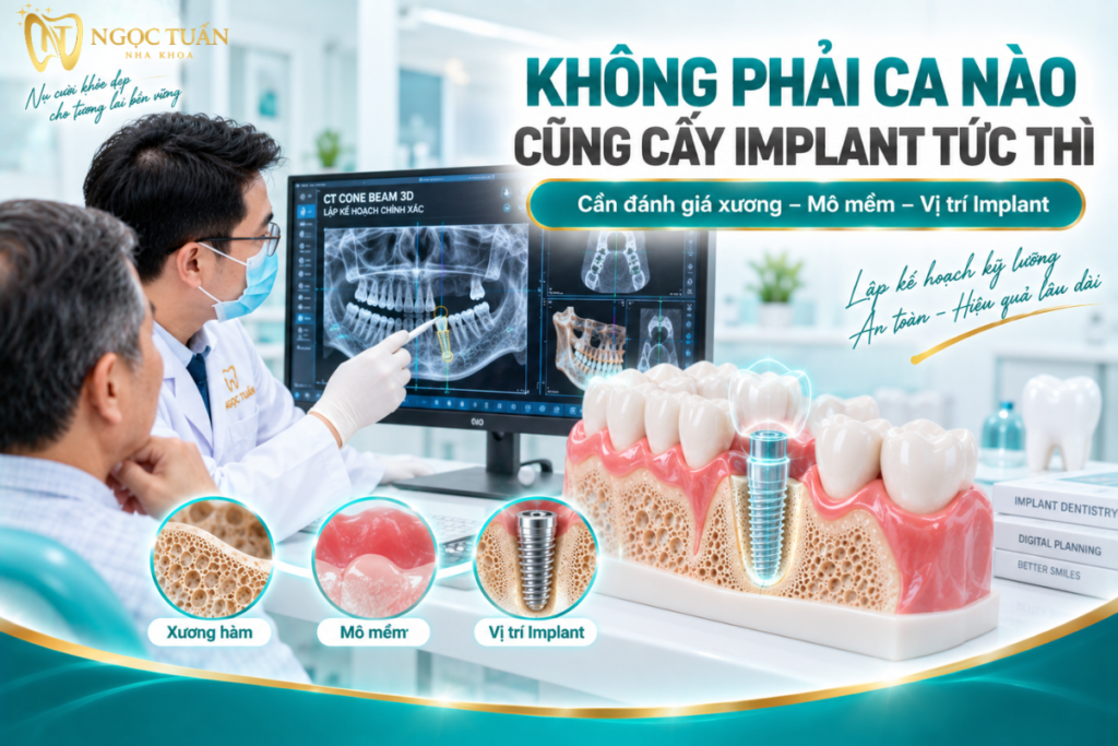 Bác sĩ cần đánh giá xương, mô mềm và vị trí Implant trước khi quyết định cấy Implant tức thì sau nhổ răng.