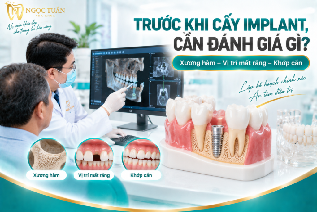 Trước khi cấy Implant, bác sĩ cần đánh giá vùng mất răng, xương hàm, khớp cắn và các cấu trúc liên quan để lập kế hoạch.