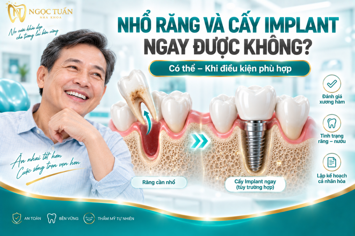 Nhổ răng và cấy Implant ngay có thể được cân nhắc khi tình trạng xương, mô mềm và vị trí đặt Implant phù hợp.