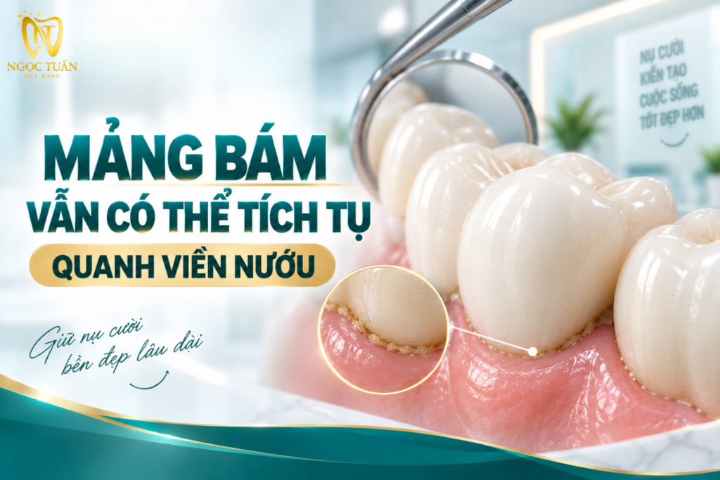 Giải thích khả năng hình thành mảng bám và cao răng quanh mão sứ.