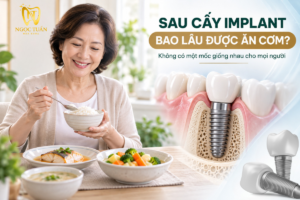 Giải đáp sau cấy Implant bao lâu được ăn cơm và cách chuyển từ thức ăn mềm sang cơm phù hợp với quá trình hồi phục.