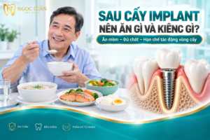 Hướng dẫn sau cấy Implant nên ăn gì và kiêng gì để đảm bảo dinh dưỡng và hạn chế tác động lên vùng vừa điều trị.