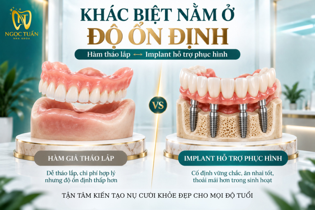 Hàm tháo lắp thông thường và phục hình có Implant hỗ trợ khác nhau về cơ chế nâng đỡ và độ ổn định.