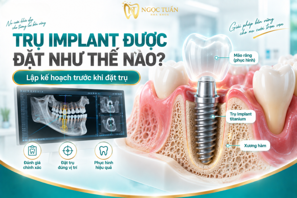 Trụ Implant được đặt vào vị trí đã được lập kế hoạch trong xương hàm nhằm tạo nền cho phục hình răng phía trên.