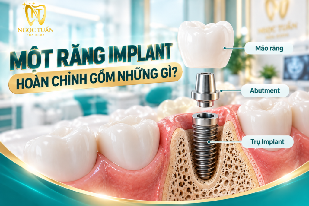 Cấu tạo răng Implant phổ biến gồm trụ Implant, Abutment và mão răng, mỗi bộ phận đảm nhiệm chức năng riêng trong phục hình.