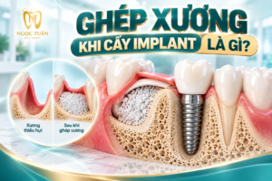 Ghép xương khi cấy Implant hỗ trợ tăng hoặc tái tạo thể tích xương tại vùng thiếu hụt, tạo điều kiện cho kế hoạch đặt trụ phù hợp.
