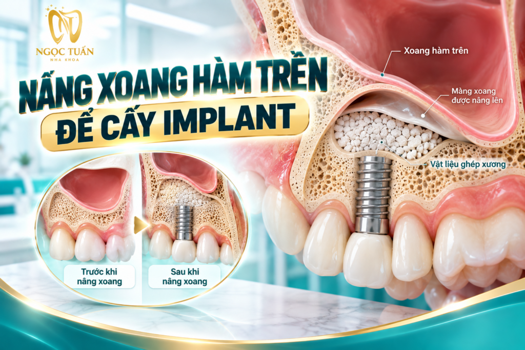 Nâng xoang hàm trên là kỹ thuật hỗ trợ tăng chiều cao xương vùng răng sau khi điều kiện xương dưới xoang chưa phù hợp để đặt Implant.