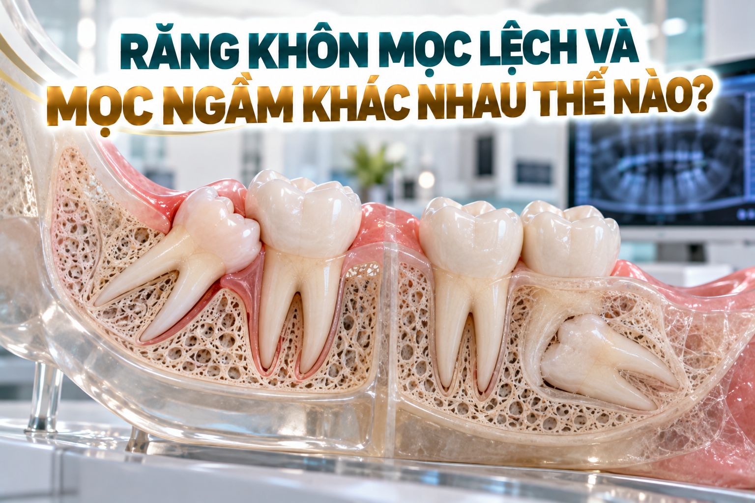 So sánh răng khôn mọc lệch và mọc ngầm dựa trên hướng mọc và mức độ răng nằm dưới nướu hoặc trong xương.