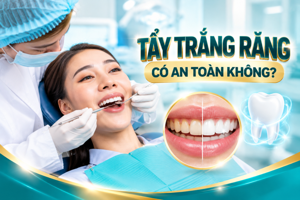 Tẩy trắng răng tại nhà bằng máng và gel theo hướng dẫn nha sĩ có thể giúp cải thiện màu răng theo liệu trình.